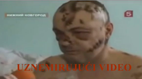 Širi se u Americi: Droga “krokodil” jede ljudsko meso iznutra (VIDEO)