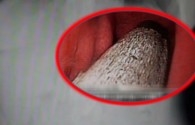 Šokirat će vas što su joj ljekari pronašli u želucu nakon 6 mjeseci bolova (VIDEO)